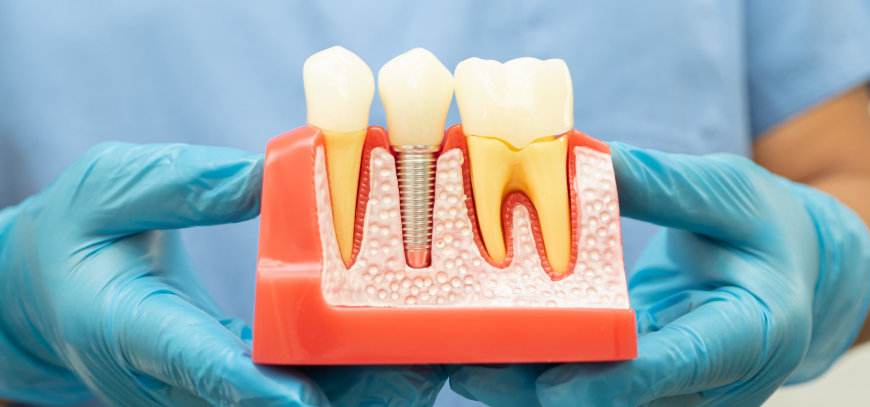 dental implants anaheim orange county ca