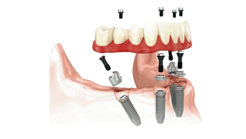 all on 4 dental implants dentist